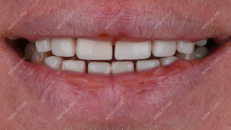 Why Chef Mike Wanted to Transform His Smile